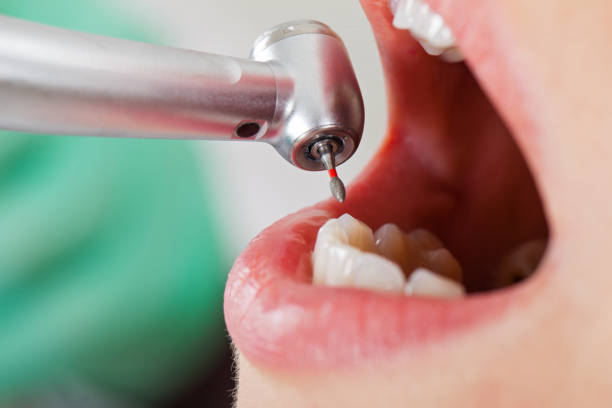 Best Emergency Dentist for Knocked-Out Tooth in Wheatland, WY